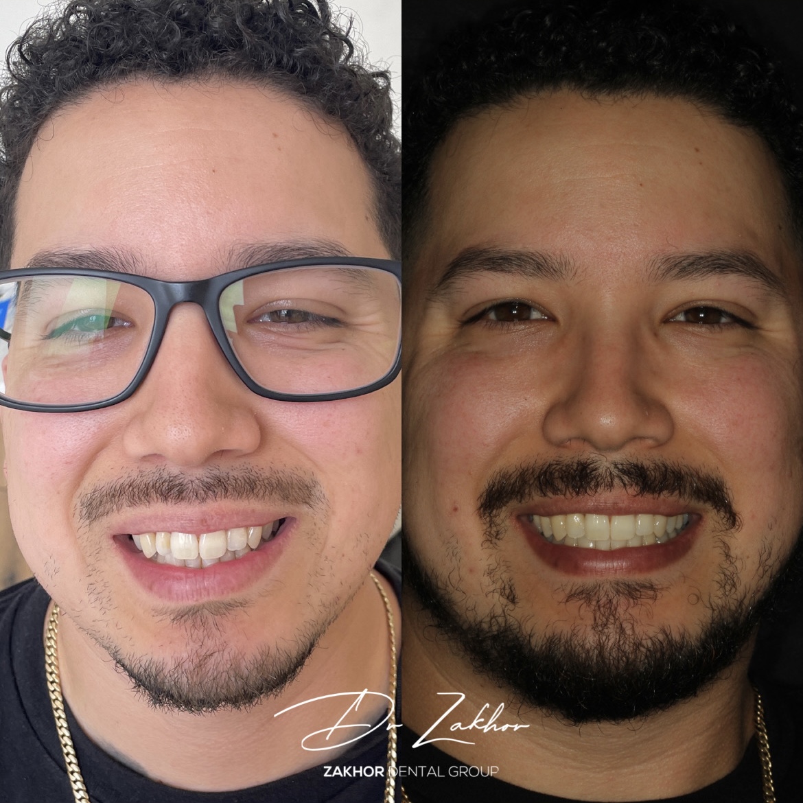 Invisalign Beverly Hills