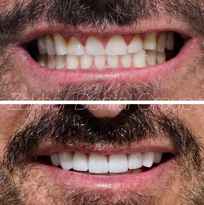 Porcelain Veneers Gallery Before After in Beverly Hills