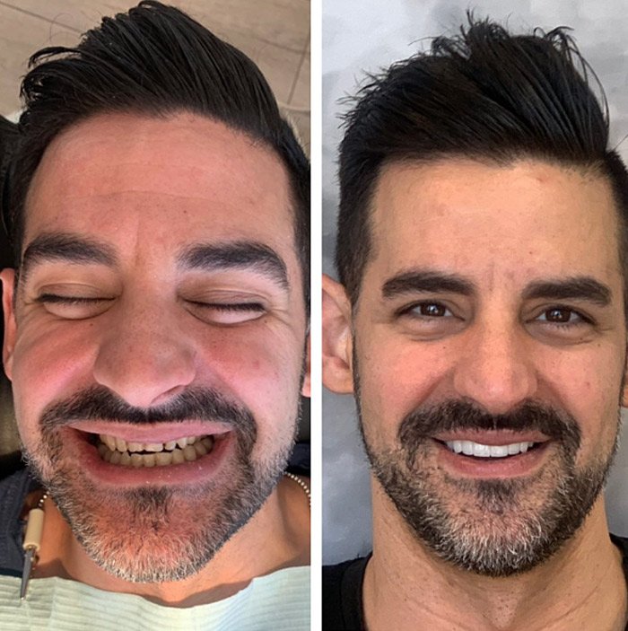 Porcelain Veneers Gallery Before After Photos in Beverly Hills